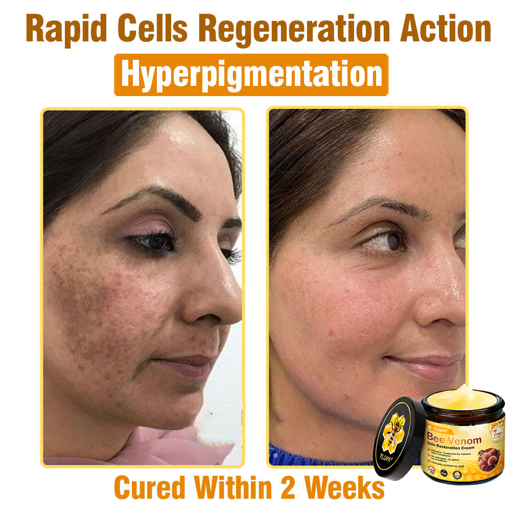 MHRA Approved: TLOPA® Bee Venom Skin Restoration Cream — 🔥Limited Time 80% OFF🔥