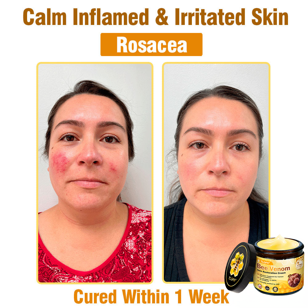 MHRA Approved: TLOPA® Bee Venom Skin Restoration Cream — 🔥Limited Time 80% OFF🔥