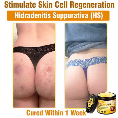 MHRA Approved: TLOPA® Bee Venom Skin Restoration Cream — 🔥Limited Time 80% OFF🔥