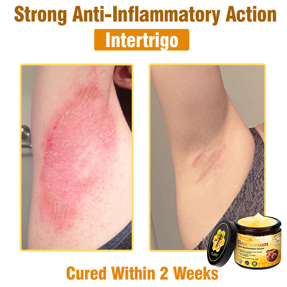MHRA Approved: TLOPA® Bee Venom Skin Restoration Cream — 🔥Limited Time 80% OFF🔥