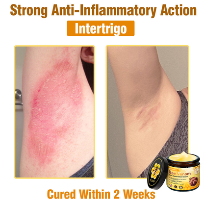 MHRA Approved: TLOPA® Bee Venom Skin Restoration Cream — 🔥Limited Time 80% OFF🔥